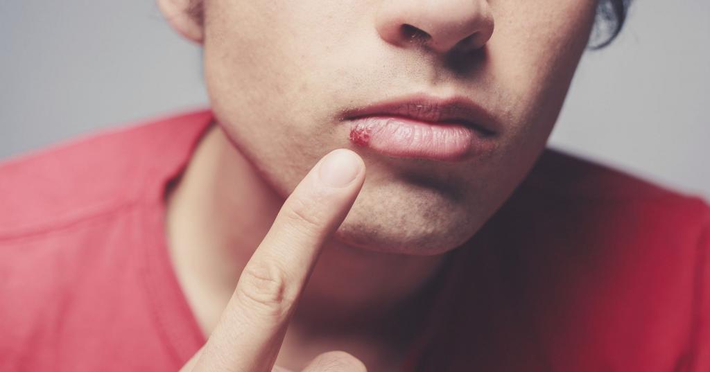 Чем отличается герпес от простуды на губах: основные симптомы, особенности лечения Здоровье