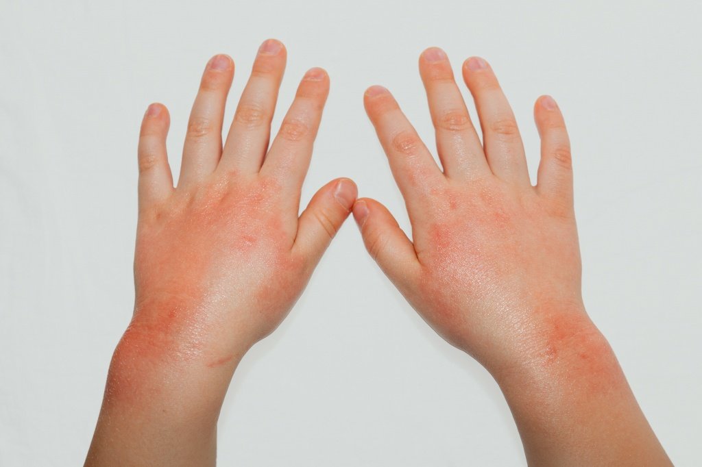 Диатез на руках у детей и взрослых: фото, симптомы и лечение Здоровье