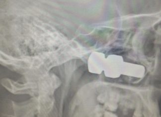 З-під колеса вантажівки вилетів болт, який потрапив в голову.