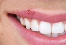 Чим відрізняється герпес від застуди на губах: основні симптоми, особливості лікування