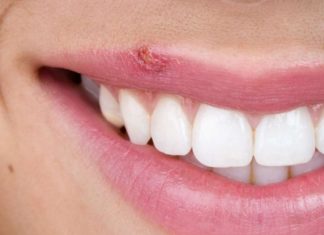 Чим відрізняється герпес від застуди на губах: основні симптоми, особливості лікування