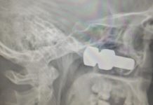 З-під колеса вантажівки вилетів болт, який потрапив в голову лесосибирцу