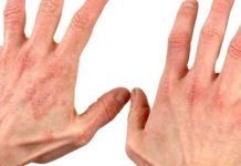 Діатез на руках у дітей і дорослих: фото, симптоми і лікування