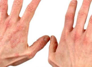 Діатез на руках у дітей і дорослих: фото, симптоми і лікування