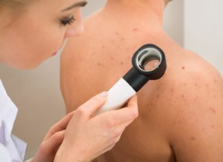 Видавлювання жировика — наслідки. Як прибрати жировик в домашніх умовах