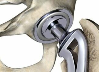 Вчені тпу представили новий спосіб створення біосумісної поверхні імплантатів